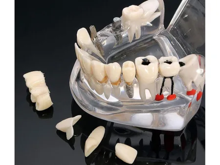 Model stomatologiczny szczęka z zębami i implantami