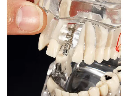 Model stomatologiczny szczęka z zębami i implantami